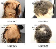 hair loss success story 100000000