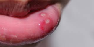 cold sores and syphilis sores