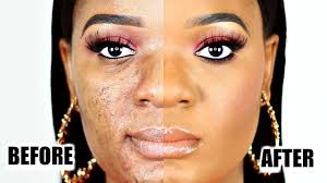 large pores acne scars py skin