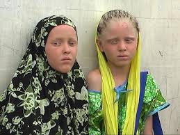 Image result for africa albinos