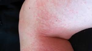 disney rash symptoms pictures