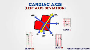 What Is Cardiac Axis Geeky Medics