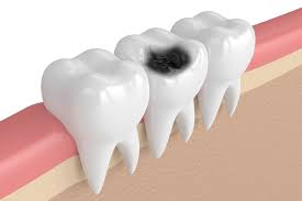 home remes to get rid of tooth decay