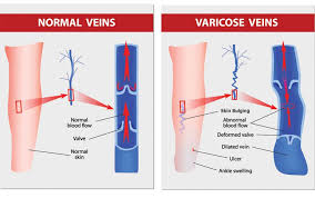 Chronic Venous Insufficiency Treatment Diagnosis Tx Vein