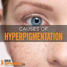 hyperpigmentation symptoms causes