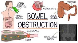 understanding bowel obstruction you