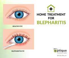 home treatment for blepharitis