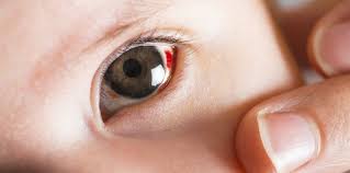 subconjunctival hemorrhage why your