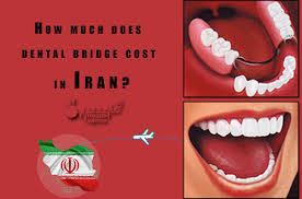 dental bridges in iran cost and types