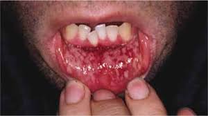diagnosing rashes part 12 lip lesions