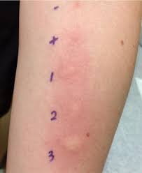 For a skin patch test, the allergen solution is placed on a pad that is taped to the skin for 24 to 72 hours. First Reported Case In Canada Of Anaphylaxis To Lupine In A Child With Peanut Allergy Allergy Asthma Clinical Immunology Full Text