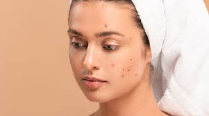 acne causes types and treatments