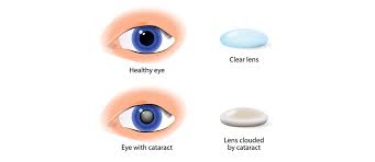 cataract surgery which is the better