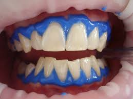hydrogen peroxide to whiten teeth