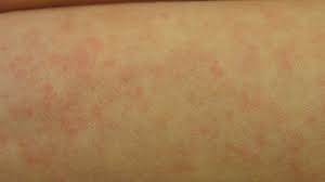 In stressful times, make stress work for you. Gallery Of Hives Pictures For Identifying Rashes