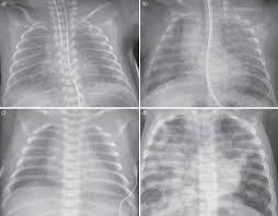 Compensatory symptom for poor pulmonary compliance—. Common Respiratory Conditions Of The Newborn European Respiratory Society