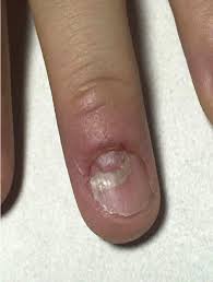 nail changes ociated with hand foot