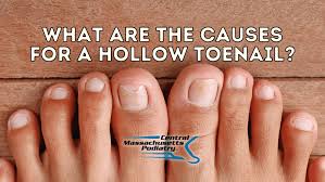hollow toenail