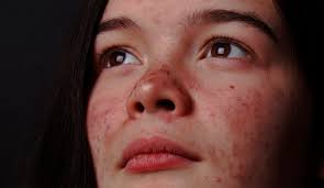 el acné tipos síntomas y tratamientos