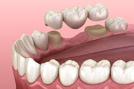 dental bridge options for replacing