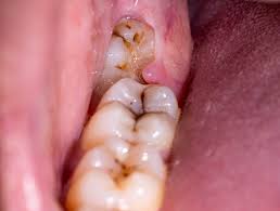 pericoronitis causes signs and