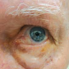 protection and signs of eyelid cancer