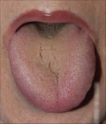 Black Coated Tongue In Integrative Medicine An Alarm Signal