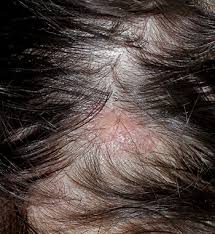 23 causes of an itchy scalp according