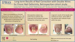 nail correction with double wires