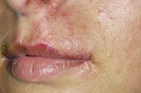 cold sores stock image m170 0451