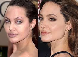 Why everyone's talking about jaw filler in 2020. Realistic Expectations From Dermal Fillers