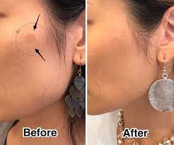 laser skin resurfacing treatment guide