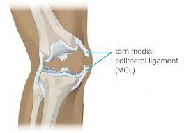 Much of the pain of an acl tear is due to the swelling of the joint. Mcl Tear Symptoms Diagnosis And Treatment