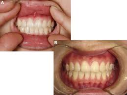 multiple gingival pregnancy tumors with