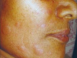 hives on face treatments symptoms