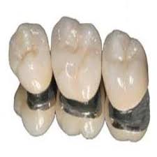 Pfm Dental Crown Pfm Dental Crowns Bridges Santacruz