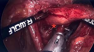 paraesophageal hiatal hernia repair