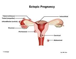 Ectopic Pregnancy Obstetrics Medbullets Step 2 3