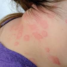 how to treat urticaria with home remes