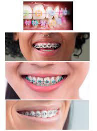 What are the Best Braces Color for You in 2023? - Orthodontic Arts