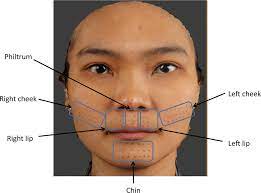 The lateral aspect of the head. 3d Image Showing 77 Facial Pre Marked Landmarks Left Cheek 18 Download Scientific Diagram