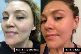 laser treatments for acne scars