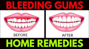 20 home remes for bleeding gums