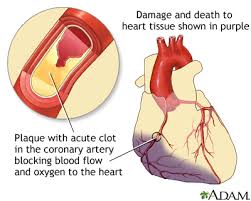 coronary disease information