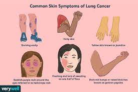 lung cancer symptoms on the skin to