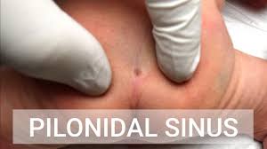 pilonidal sinus with dysmenorrhoea