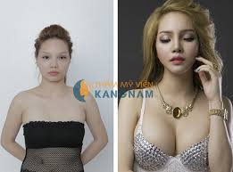 Trước và sau khi phẫu thuật gọt mặt tại thẩm mỹ viện kangnam