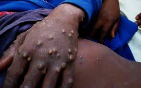 Get the facts on treatment, prevention. No Malaysian Infected With Monkeypox Says Health Ministry Free Malaysia Today Fmt