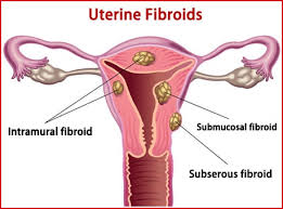 Uterine Fibroids Ayurvedic Treatment With Herbal Remedies