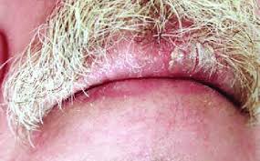 psoriasis of the lips